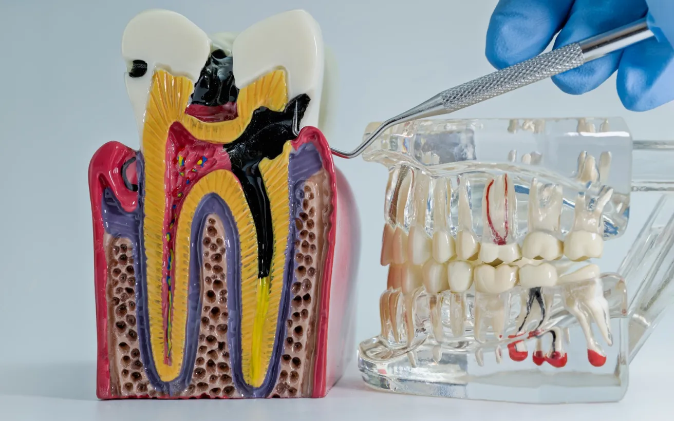 Root Canal Pain: The Myth, the Reality, and What Actually Happens