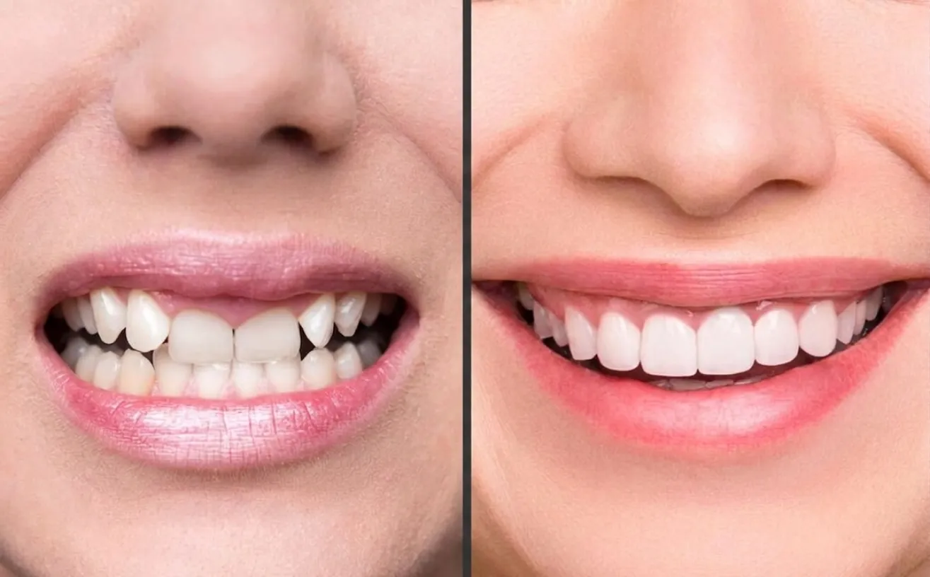 Smile Design: What Actually Happens Before We Touch a Single Tooth