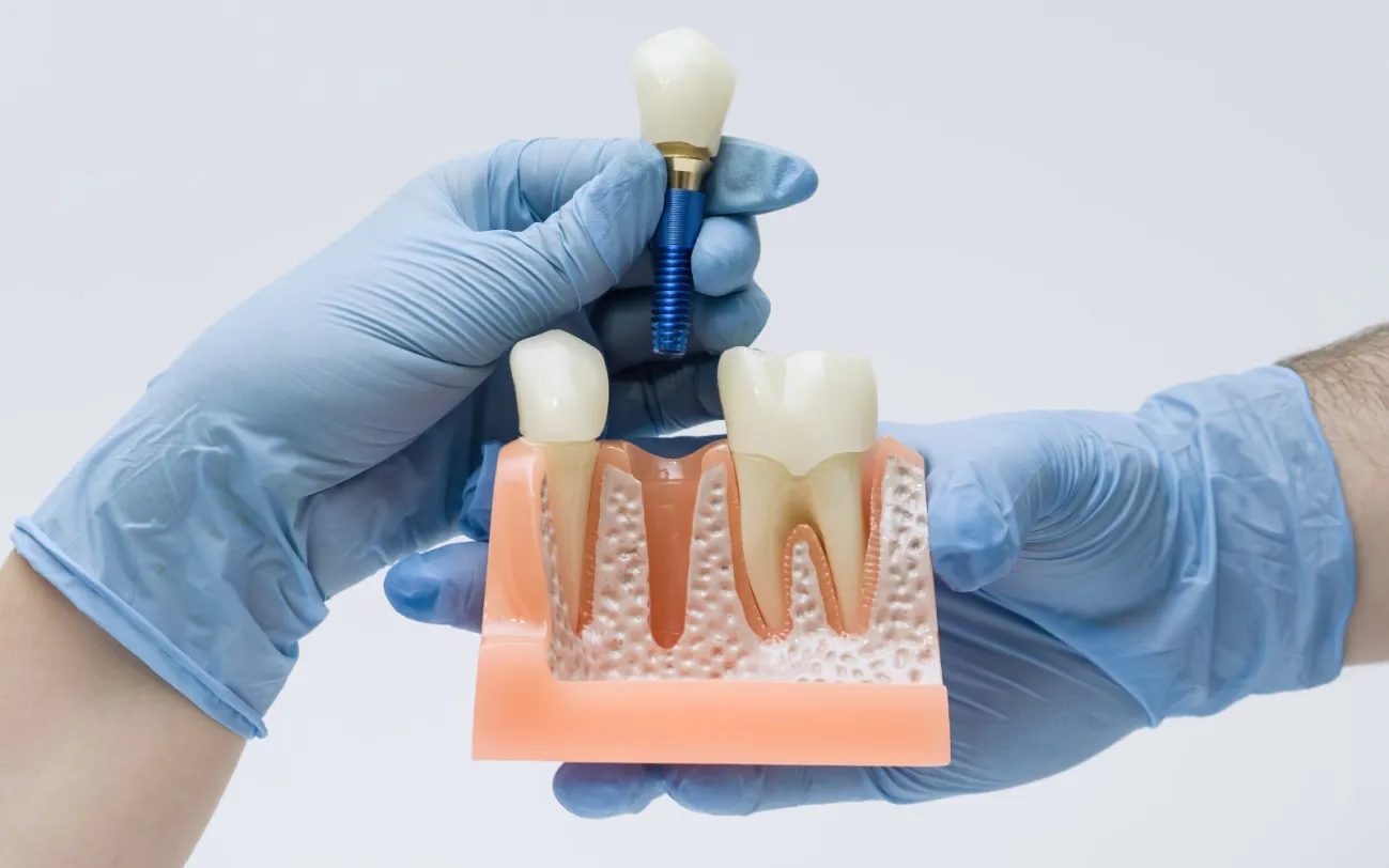 The Real Cost of Dental Implants in Noida — A Patient's Honest 2026 Guide