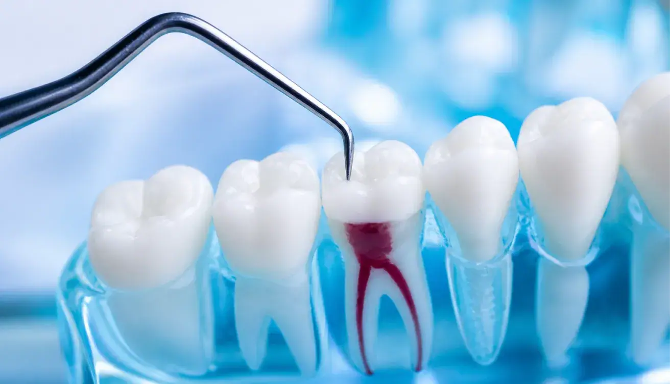 Root Canal Treatment: Myths vs Facts You Should Know