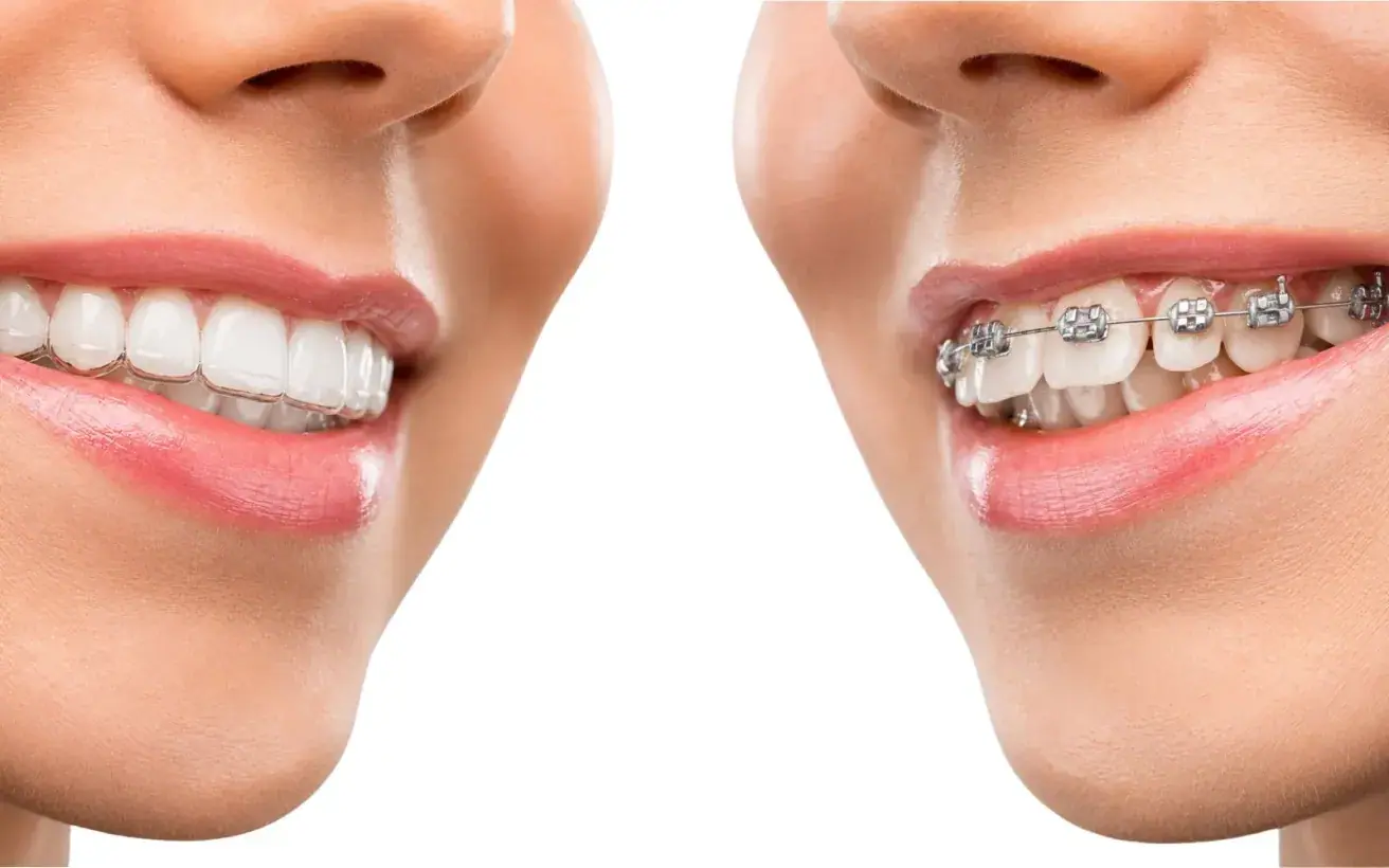 Invisalign vs Braces: Which Is Better for Adults?