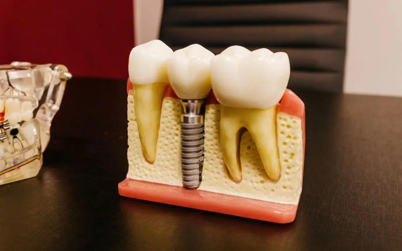 Dental Implant Cost in Noida 2026: What to Expect