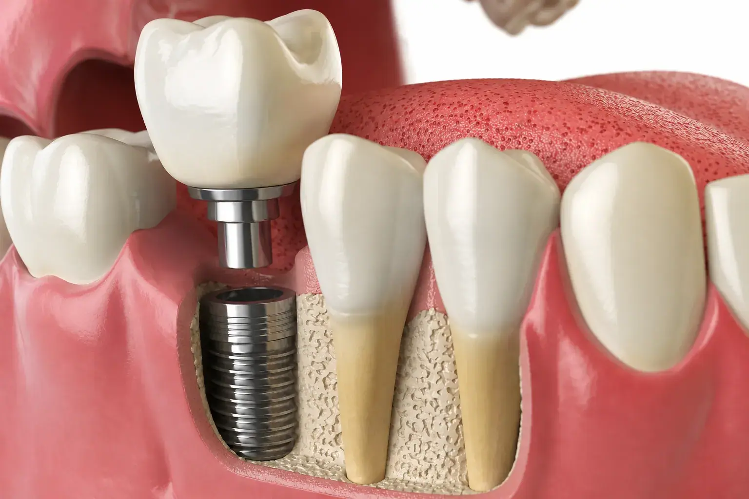 How Long Does a Dental Implant Last? An Evidence-Based Answer